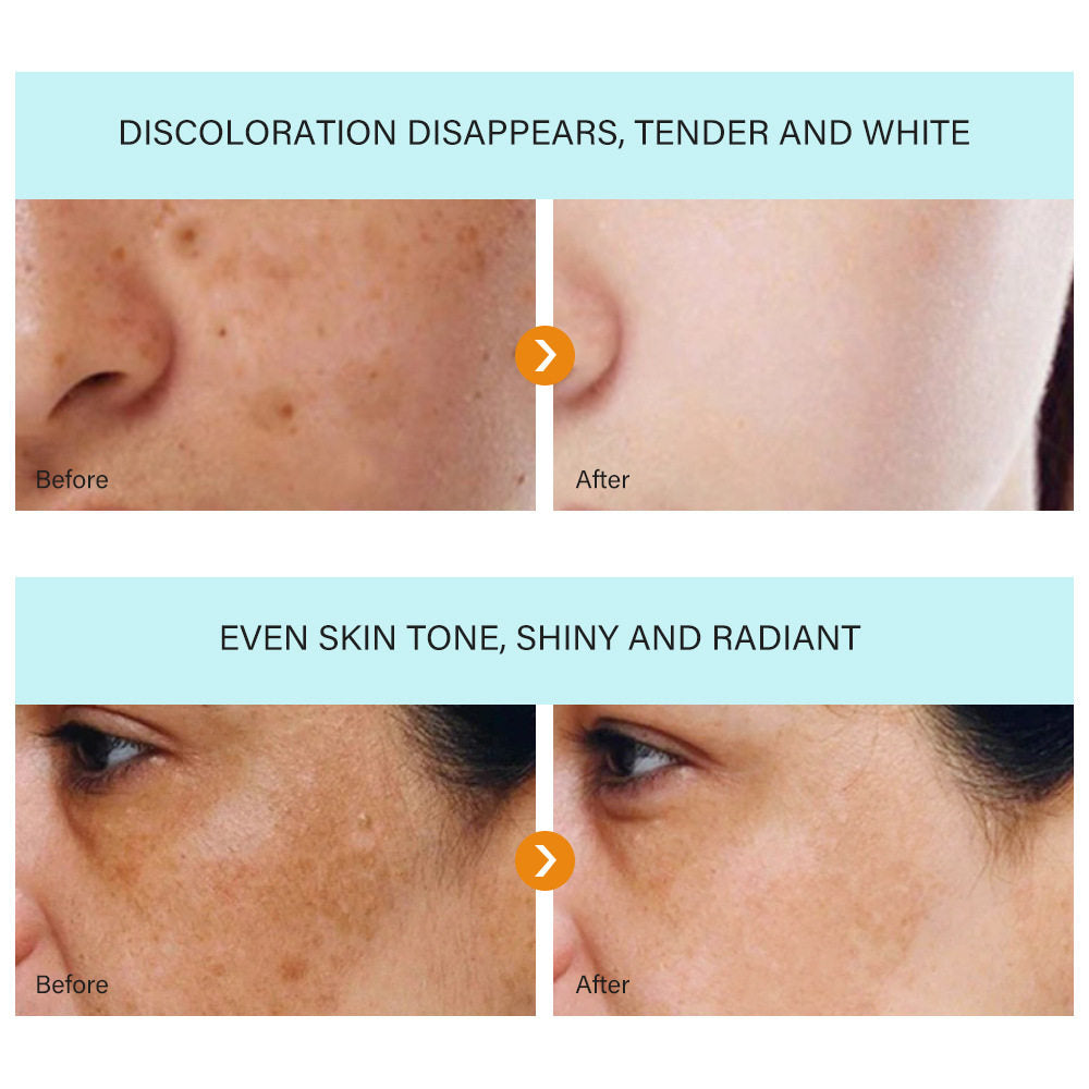 Dark spot removal face cream - 3 pieces